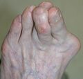 Overlapping-toes.jpg
